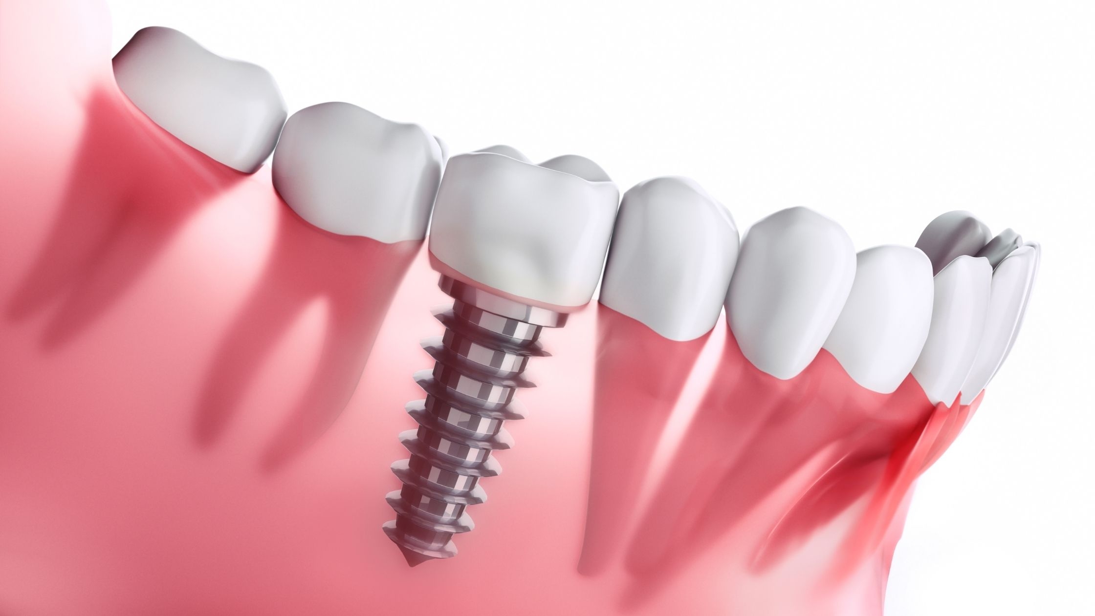 all on 4 dental implants