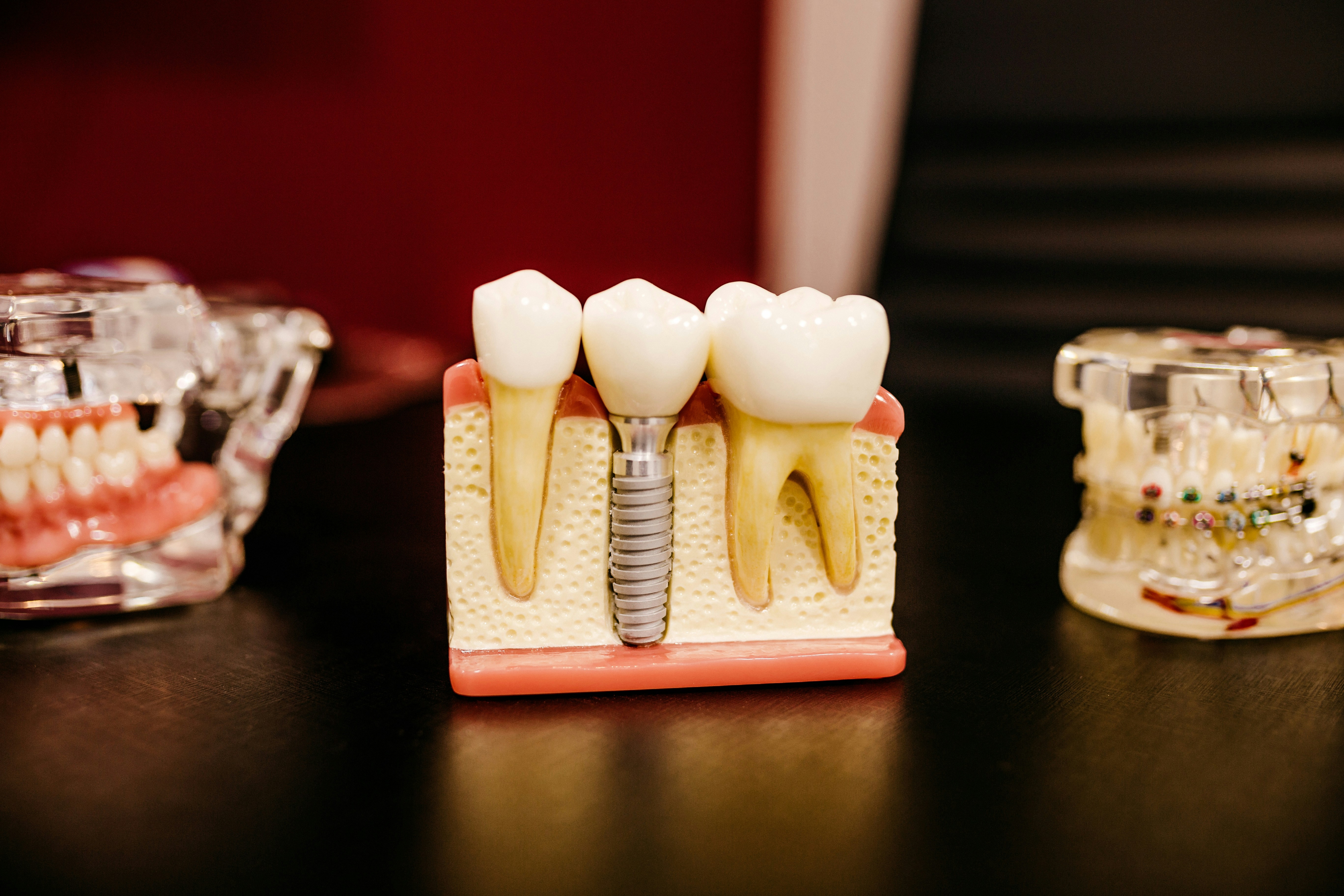 dental-implants